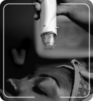 Untitled design 13 rf microneedling