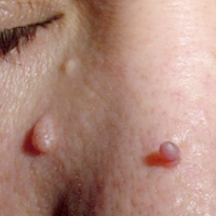 Cryopen Skin Tag removal