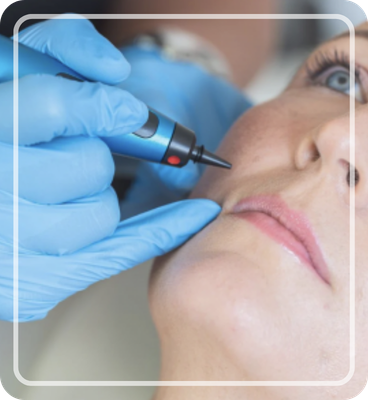 Untitled design 13 CryoPen treatment Pangbourne